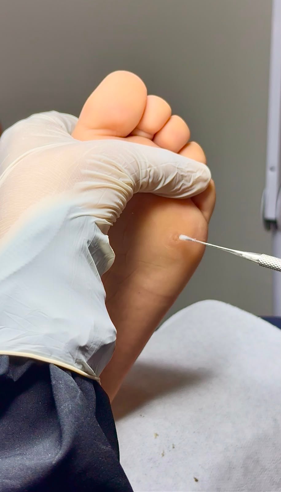 Tratamiento de verruga plantar (papiloma) en la planta del pie