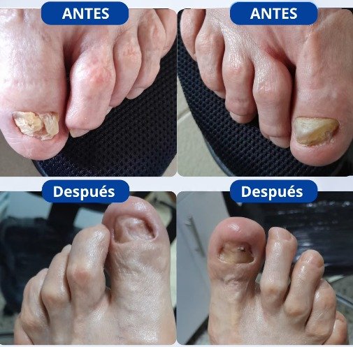 Antes y después de tratamiento de onicomicosis