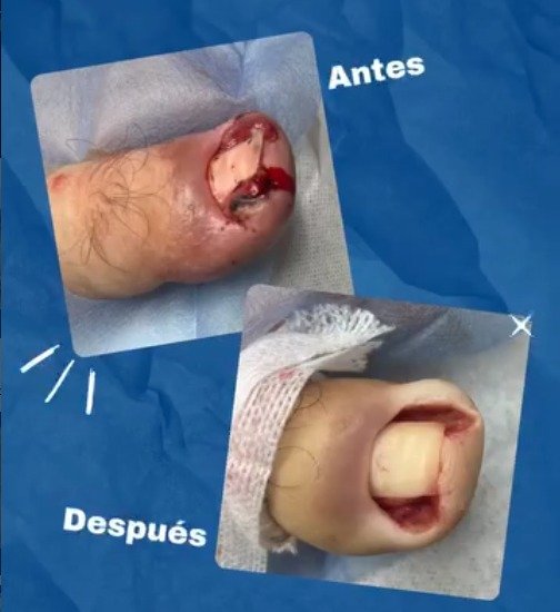 Antes y después de cauterización de uña encarnada